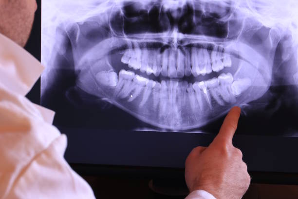 Best Emergency Dentist for Lost Fillings or Crowns in Burton, SC